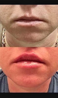 Juvederm lip injections 1 syringe