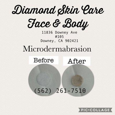 Microdermabrasion