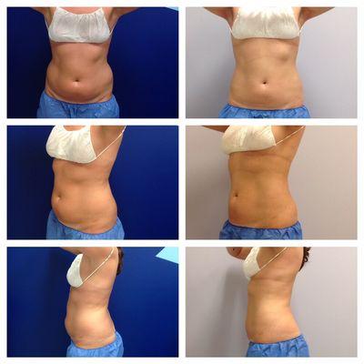 Amazing results on one of our Coolsculpting clients!