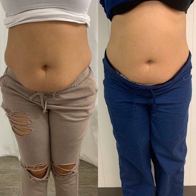 Before and After A few sessions of Non Invasive Lipo Dear Body By Tiera