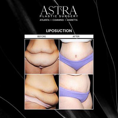 Liposuction achieves a slimmer, more toned midsection by removing unwanted fat and excess skin to produce natural-looking results.