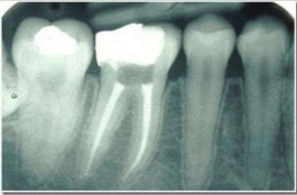 Gentle & Easy Root Canal Treatments To Save Your Tooth