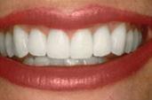 "Whitening"