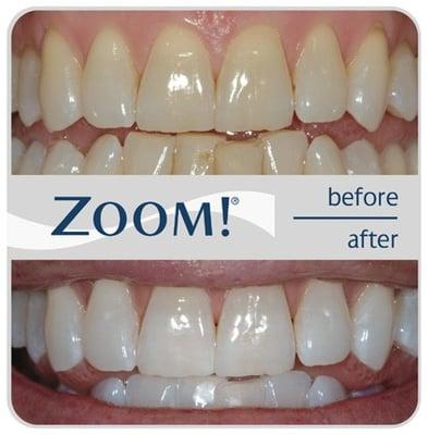 Zoom , get up to 5 shades lighter than your teeth... !