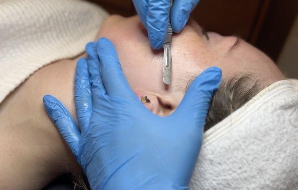 Dermaplaning