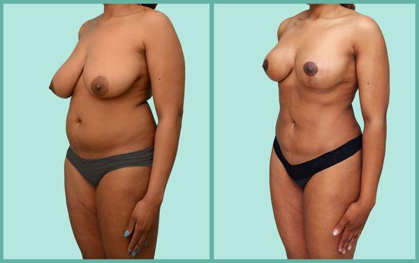 Breast Lift and Aquashape Liposuction