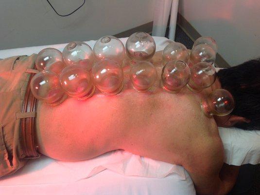 Patient is having cupping treatment.