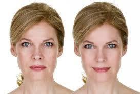 Dermal fillers and botox to minimize fine lines and wrinkles.