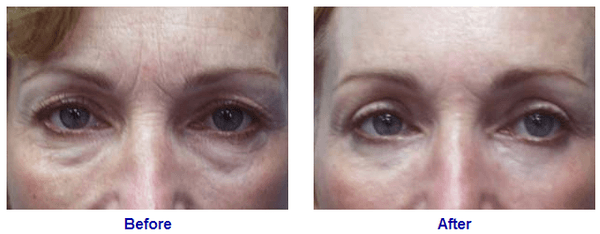 Eyelid Surgery, Palo Alto Blepharoplasty