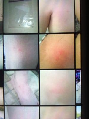 Bed bug bites