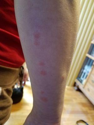 More Bed Bug Bites