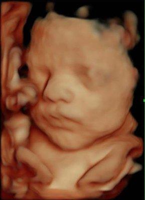 3D/4D/HD Live Ultrasound