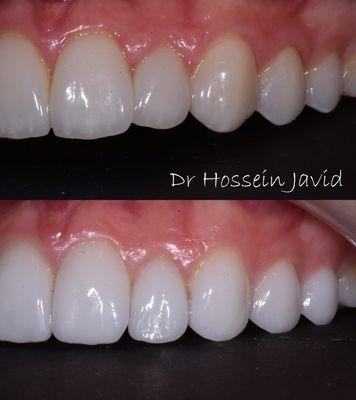 Replacing 10 Veneers Done twice by 2 different Doctors, both in #Beverly Hills