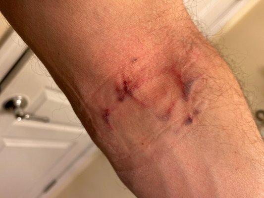 Blood draw wound from LabCorp Exton