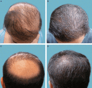 Body Hair Transplant Before and After Results - saved from baldness - BHT Transplant - Dr. U Skin & Hair Clinic