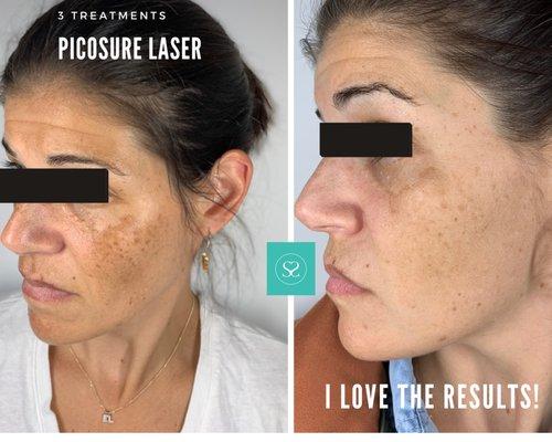 Skin Rejuvenation - remove unwanted pigment, fine lines