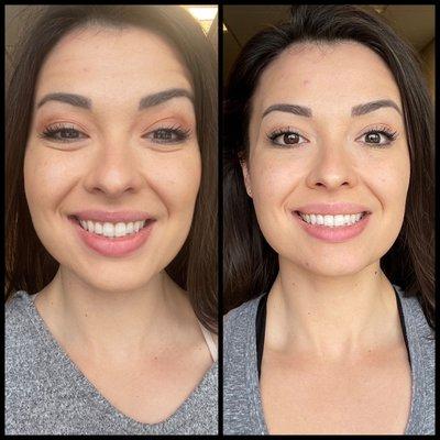 Before treatment (left) and immediately after treatment (15-20 minutes later) (right)