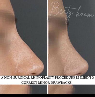 Non surgical rhinoplasty