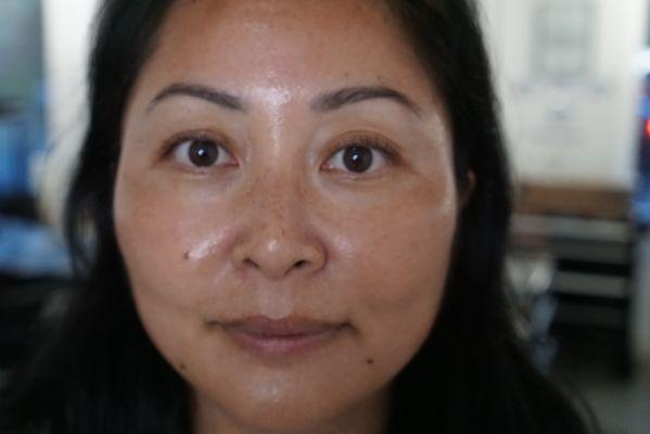 Glowing after her chemical peel