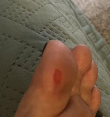 Cut toe from a pedicure.