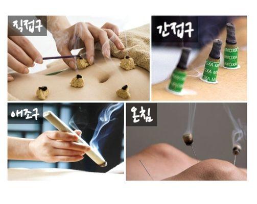 MOXIBUSTION or MOXA is a method of heating specific acupuncture points on the body by burning dried korean mugwort close to the skin.