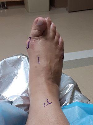 Before pic . . pain all the time, like a knife turning in the joint of big toe.