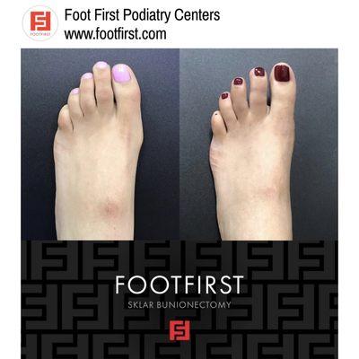 The Sklar Bunionectomy® and Toe Shortening