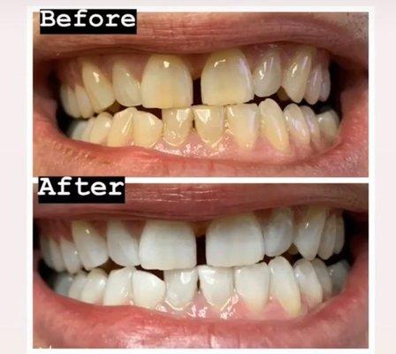 Zoom! Teeth Whitening- Before & After! Call now to book (516)308-7121!