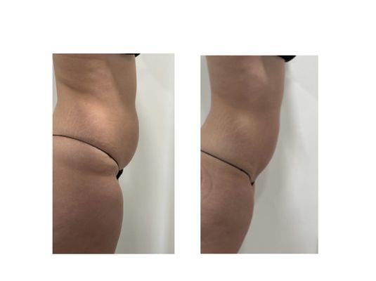 Cavitation & Laser Lipo. Get rid of inches  and sculpt with every treatqment