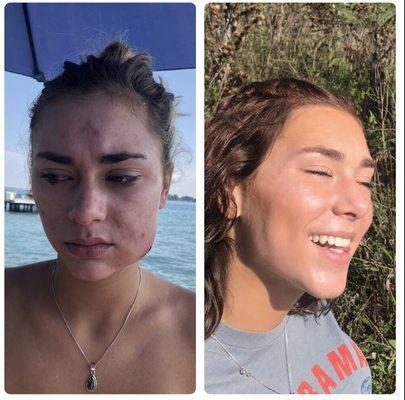 Dr. Grekin changed my 19 year old's life! Her skin is beautiful in just 3 months!