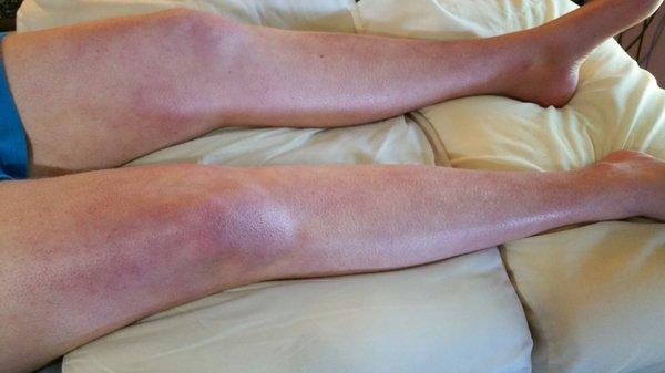 CRPS in my daughter's legs one year after Travis said she was 80% healed.