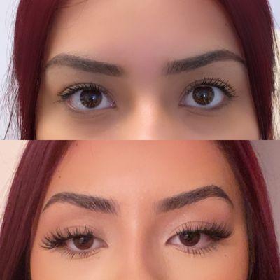 Botox brow lift