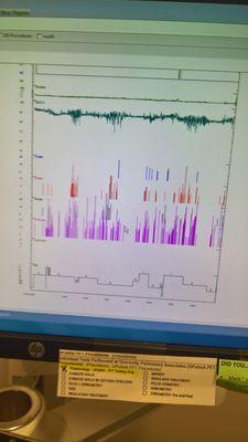 Damning 'Sleep study' evidence of 33 events or more an hour! Now averaging .6 to 1.2! I'll take it!