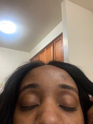 Threaded brows left brow has no arch