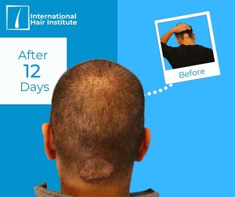 International Hair Institute - Hair Transplant Chicago