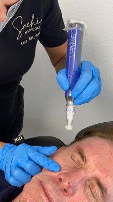 Microneedling with Skin Pen Plus