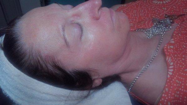 Before Dermaplan Facial Picture