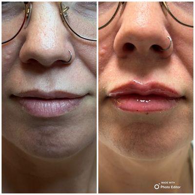 Versa Lip Filler