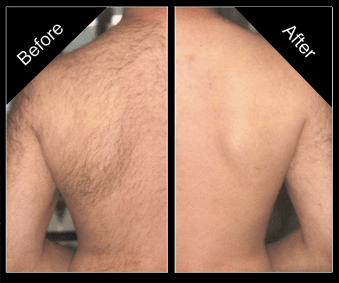 Before & After Men's Back Sugaring