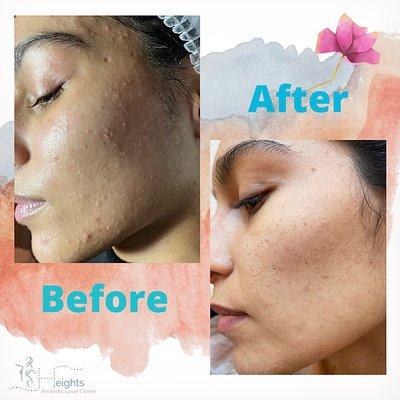 Acne treatment. Facial with LaseMD laser combination give outstanding results.