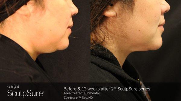 Permanent chin sculpting with Sculpsure fat melting