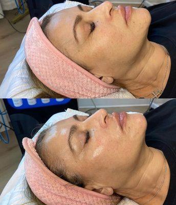 Hydrafacial Glow!