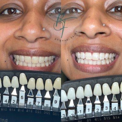 Teeth whitening with food grade ingredients and dental grade laser