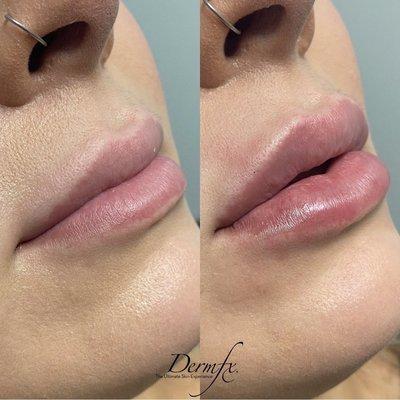 One syringe of Juvederm Ultra Plus in the lips.