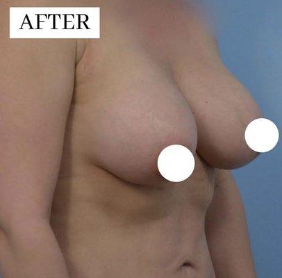 Silicone Breast Augmentation