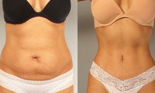 Before and After : Tummy Tuck