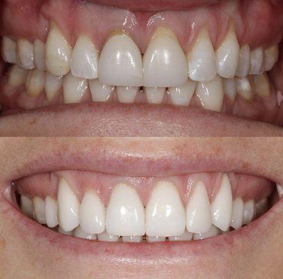 Patient wanted to improve her smile with veneers