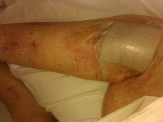 Picture of mother's knee, leg from lack if attention at Care One Valley