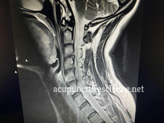 MRI of Cervical Spondylosis