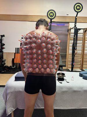 Cupping